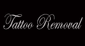 tattoo removal at urban tattoo